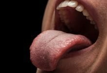 aliviar las quemaduras en la lengua - Granos en la lengua: principales causas y como quitarlos