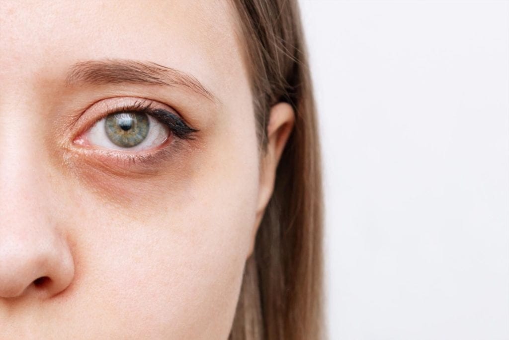 ojeras