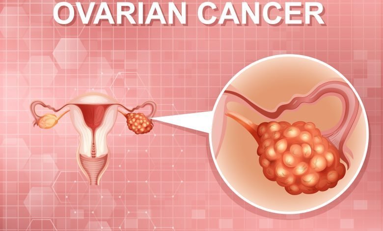 Ilustración de cáncer de ovario en un sistema reproductor femenino