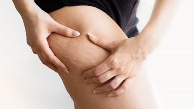 Foto de chica sosteniendo y empujando la piel de las piernas para mostrar la celulitis - Cómo eliminar la celulitis rápidamente