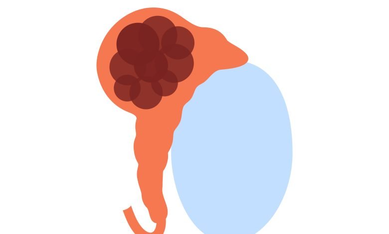 Ilustración de cáncer de testículo
