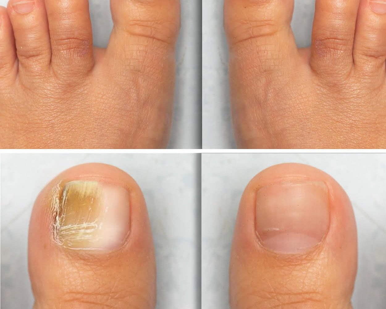 Foto de uñas del pie, antes y después de tratamiento contra onicomicosis
