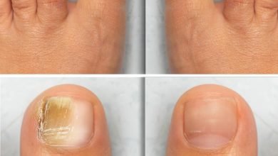 Foto de uñas del pie, antes y después de tratamiento contra onicomicosis