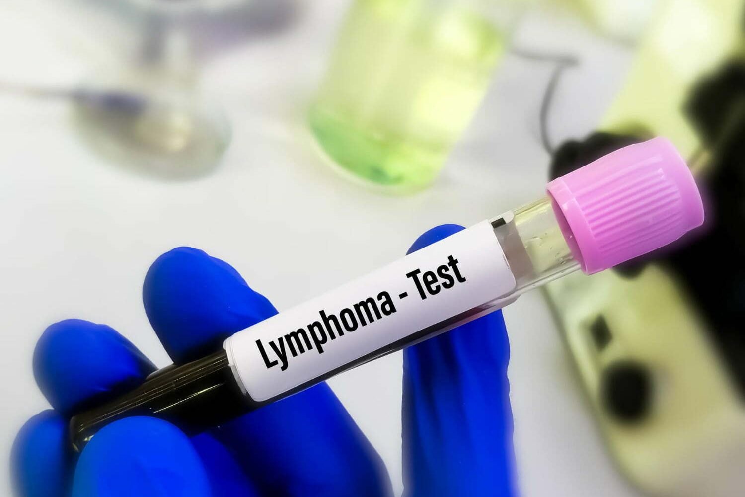 foto de prueba de sangre para detectar linfoma