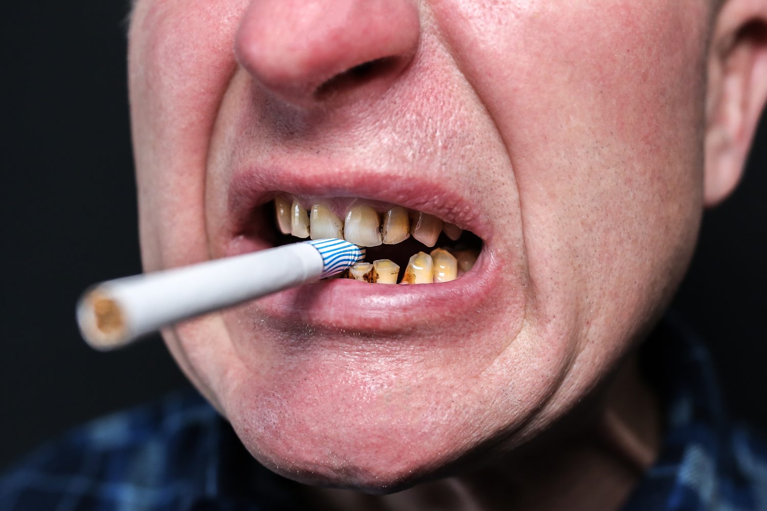 El devastador impacto del tabaquismo en sus dientes y encías