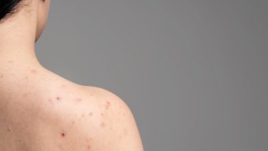 Adiós al acné en la espalda: formas eficaces de desterrar esas molestas manchas